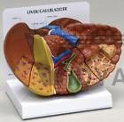 Liver w Pathologie​s Anatomical Model